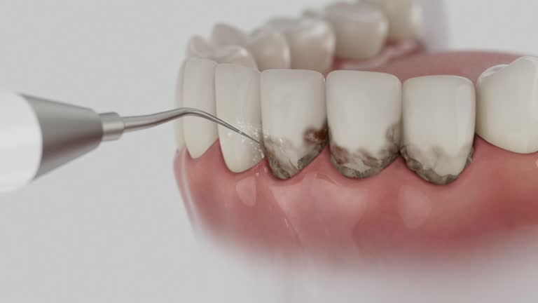 Reliable Dental Implants contractor in Bicknell, IN by Smile Center Dentistry